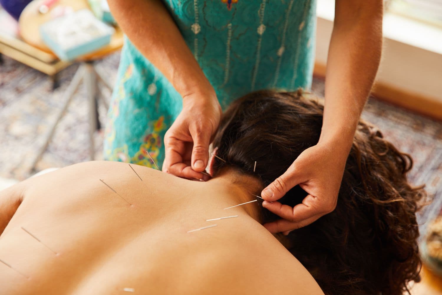 Acupuncturist placing needles on a patient's back during treatment at Health Pointe Jacksonville, FL