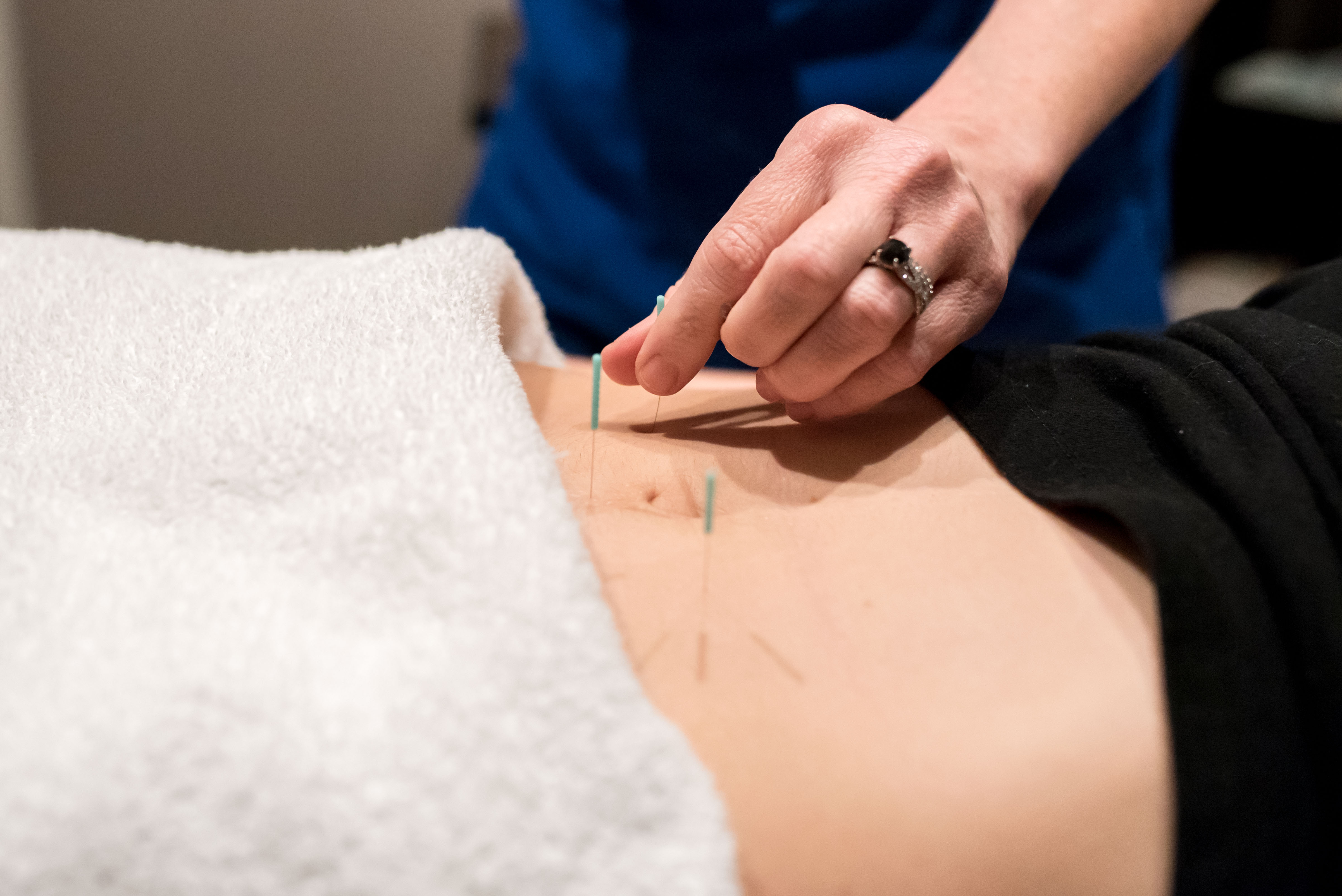 Acupuncture needles placed in a patient's abdomen during a fertility treatment at Health Pointe Jacksonville