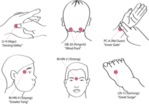 Diagram of six acupressure points for migraine relief: LI-4 Hegu, GB-20 Fengchi, PC-6 Nei Guan, M-HN-9 Taiyang, M-HN-3 Yintang and LIV-3 Taichong