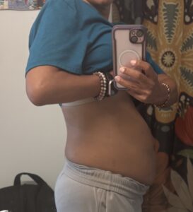 Chronic severe belly bloat left undiagnosed for 20 years
